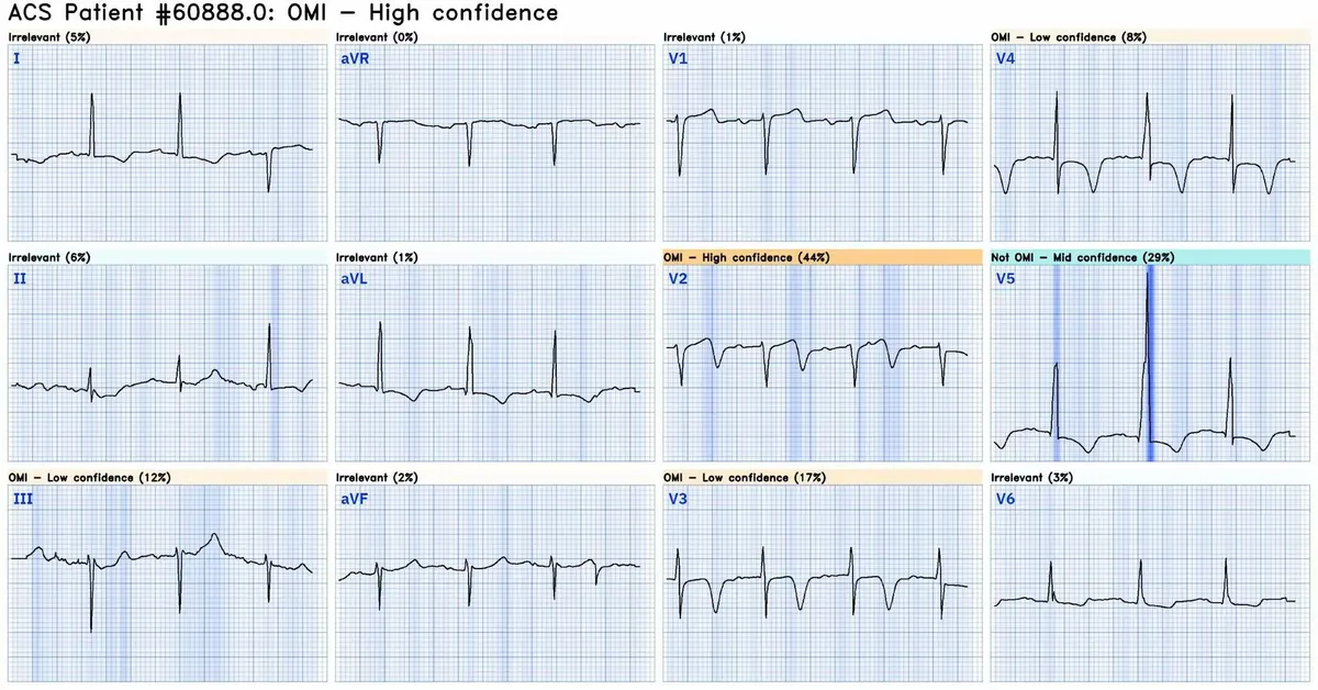 QoH ECG interpretation