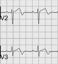 Type A Wellens