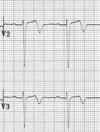 Type A Wellens