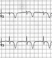 Type B Wellens