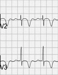 Type B Wellens