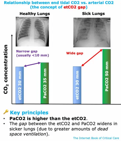 etc0<sub>2</sub> - pac0<sub>2</sub> dead space concentration