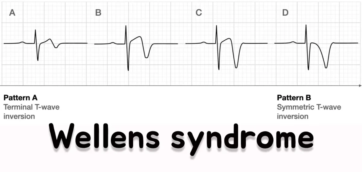 Wellens Syndrome Hero Image