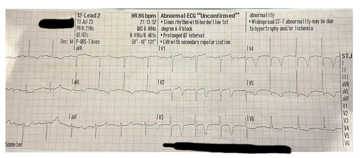 Wellens ECG